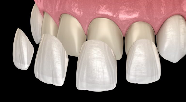 Dental Veneers 768x425