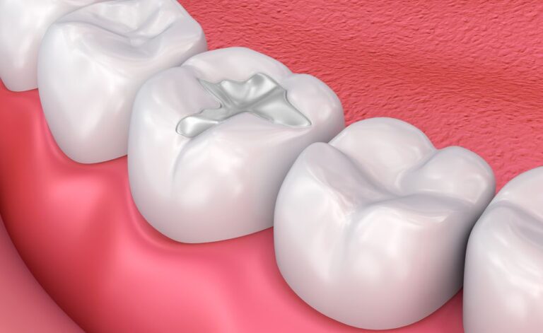 Fillings 768x471