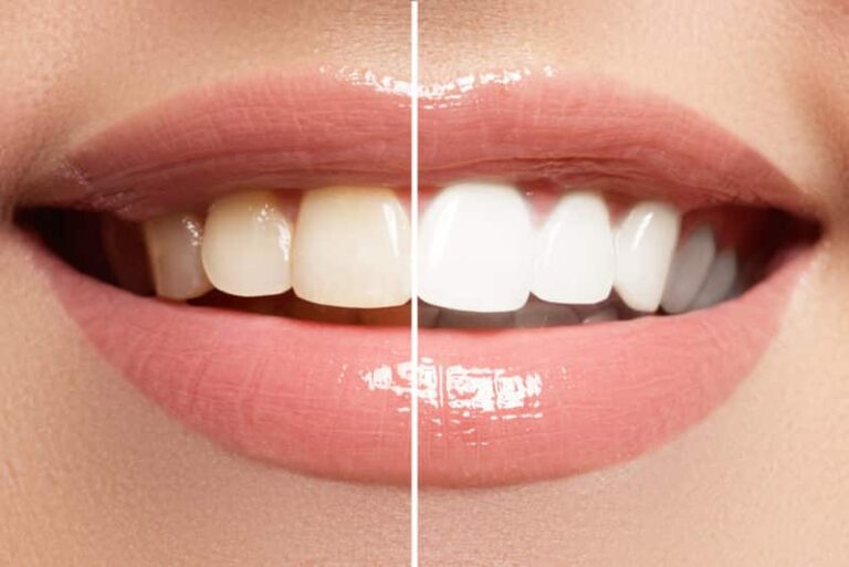 Professional Teeth Whitening 768x513
