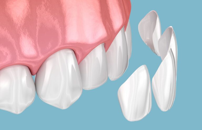 image of composite veneers 768x494
