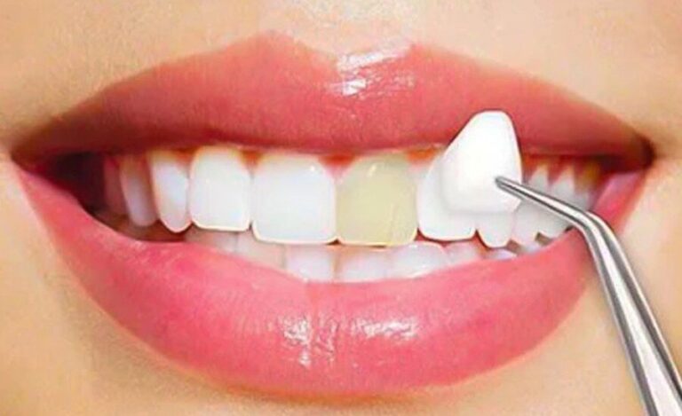 procelain veeners cosmetic dentistry procedures 768x469